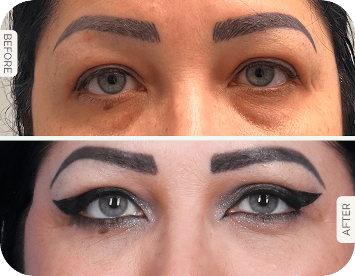 Miami Upper Eyelid Lift Before & After Gallery - Patient 125966 - Image 1 - The Chopra Plastic Surgery Center