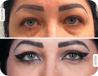 Miami Upper Eyelid Lift Before & After Gallery - Patient 125966 - Image 1 - The Chopra Plastic Surgery Center