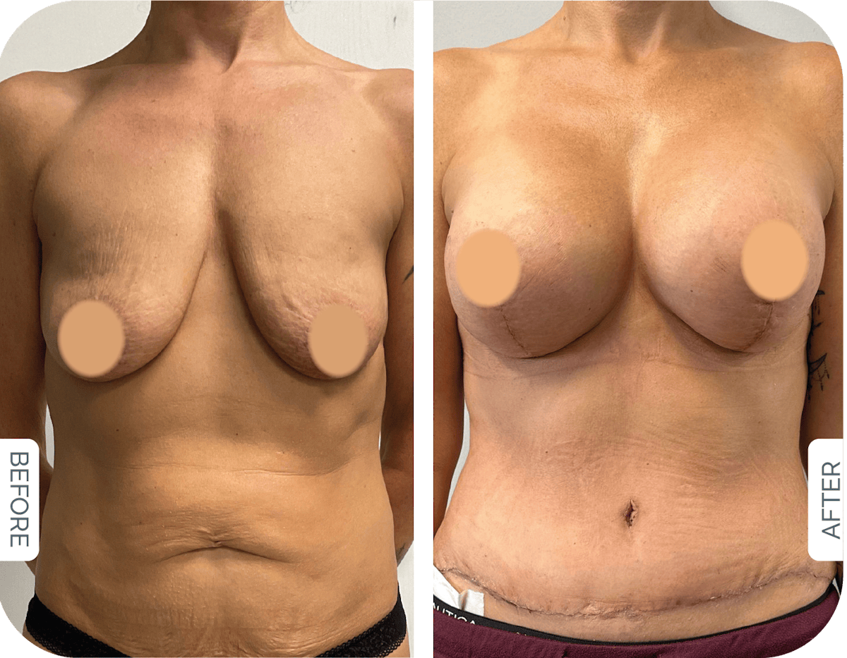 Miami Breast Augmentation Before & After Gallery - Patient 282008 - Image 1 - The Chopra Plastic Surgery Center