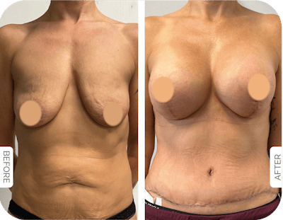 Miami Breast Augmentation Before & After Gallery - Patient 282008 - Image 1 - The Chopra Plastic Surgery Center