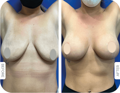 Miami Breast Augmentation Before & After Gallery - Patient 618327 - Image 1 - The Chopra Plastic Surgery Center