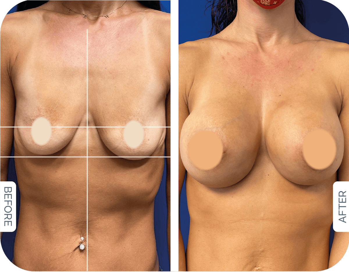 Miami Breast Augmentation Before & After Gallery - Patient 365681 - Image 1 - The Chopra Plastic Surgery Center