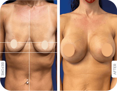 Miami Breast Augmentation Before & After Gallery - Patient 365681 - Image 1 - The Chopra Plastic Surgery Center