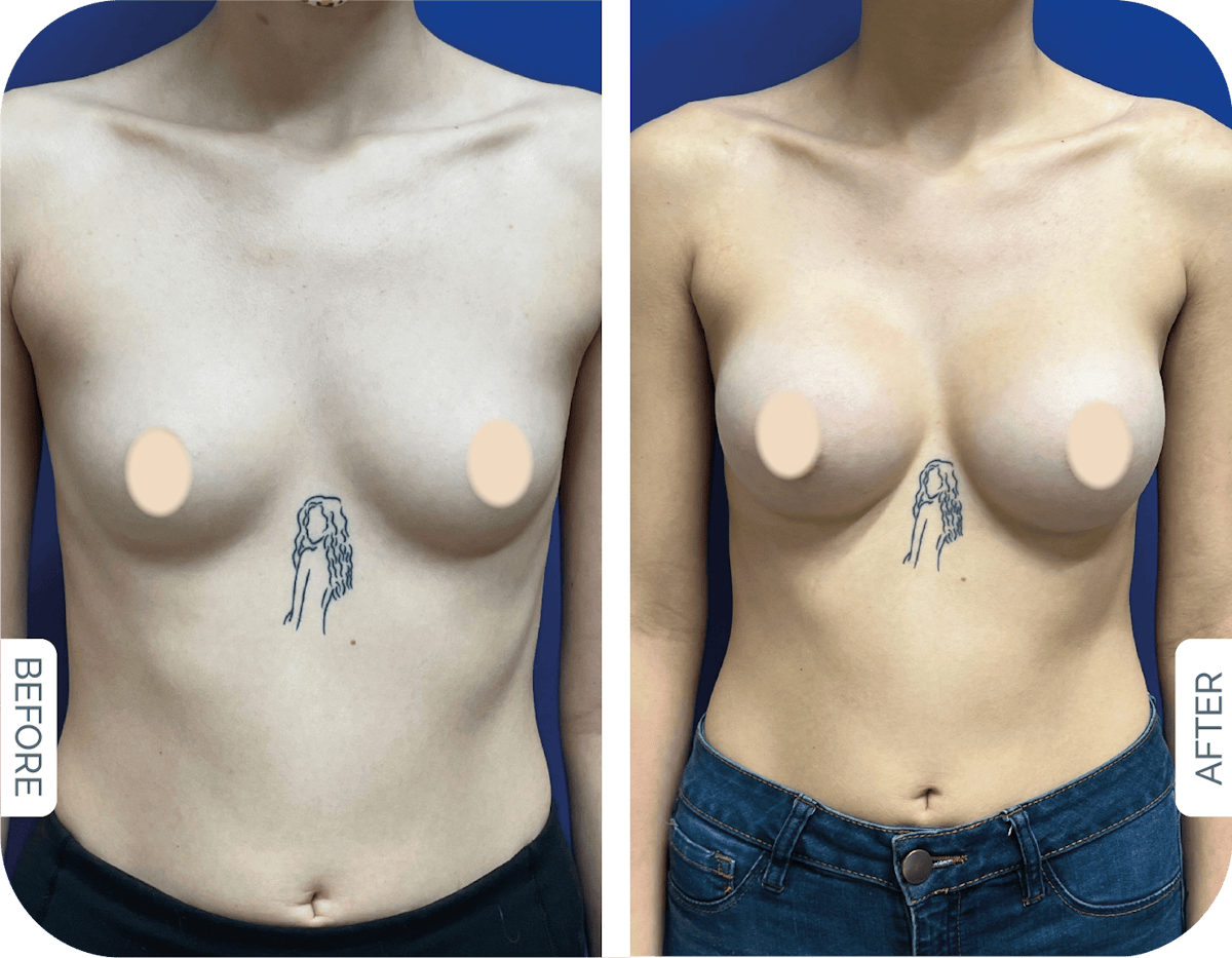 Miami Breast Augmentation Before & After Gallery - Patient 427413 - Image 1 - The Chopra Plastic Surgery Center