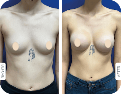 Miami Breast Augmentation Before & After Gallery - Patient 427413 - Image 1 - The Chopra Plastic Surgery Center