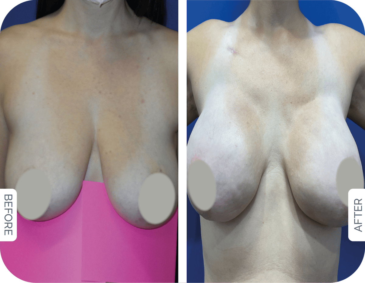 Miami Breast Reconstruction Before & After Gallery - Patient 769641 - Image 1 - The Chopra Plastic Surgery Center