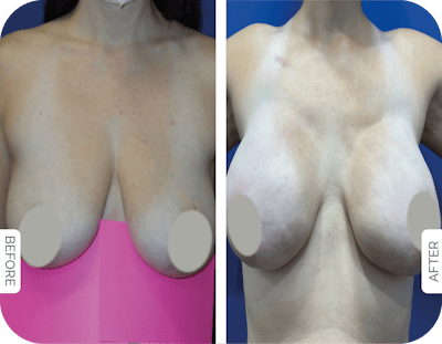 Miami Breast Reconstruction Before & After Gallery - Patient 769641 - Image 1 - The Chopra Plastic Surgery Center