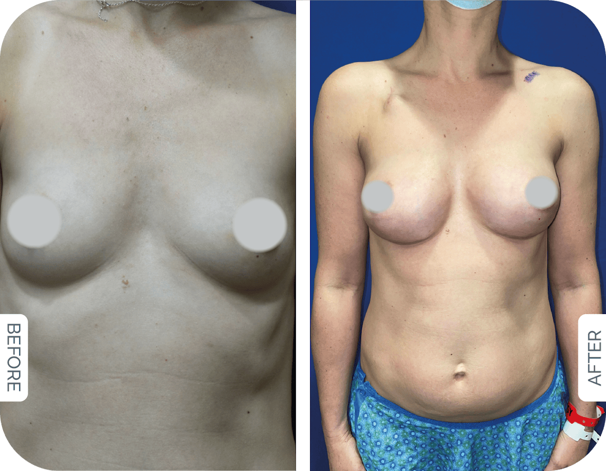Miami Breast Reconstruction Before & After Gallery - Patient 101384 - Image 1 - The Chopra Plastic Surgery Center
