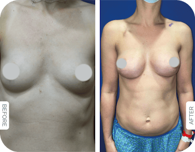 Miami Breast Reconstruction Before & After Gallery - Patient 101384 - Image 1 - The Chopra Plastic Surgery Center
