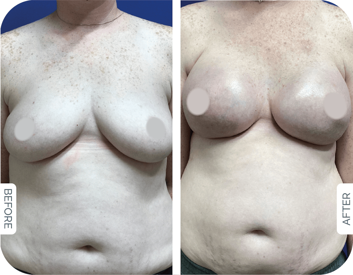 Miami Breast Reconstruction Before & After Gallery - Patient 403853 - Image 1 - The Chopra Plastic Surgery Center