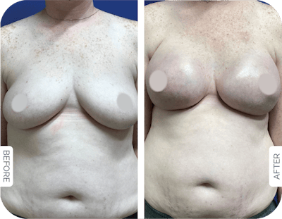 Miami Breast Reconstruction Before & After Gallery - Patient 403853 - Image 1 - The Chopra Plastic Surgery Center
