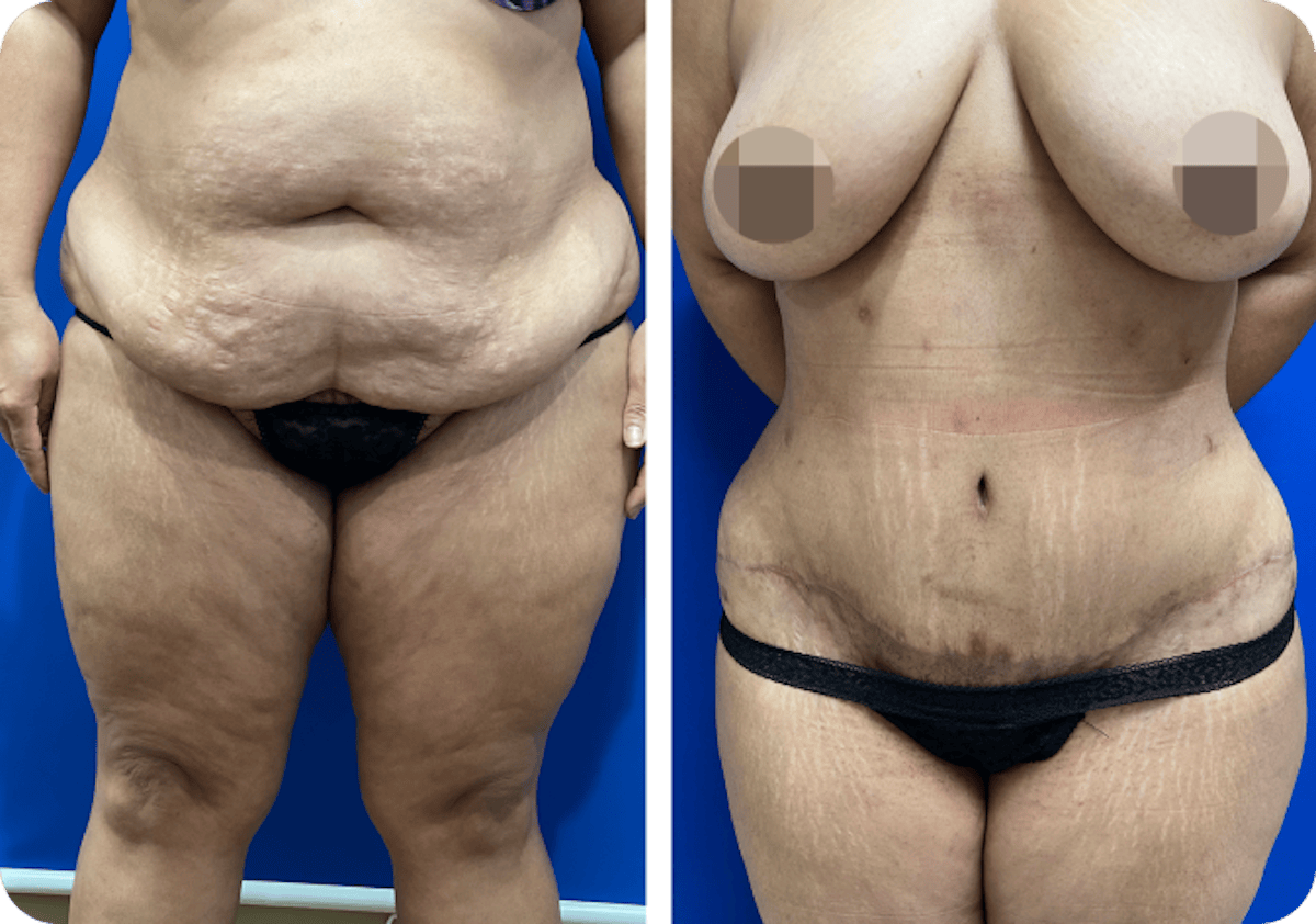 Miami Drainless Tummy Tuck Before & After Gallery - Patient 114249 - Image 1 - The Chopra Plastic Surgery Center