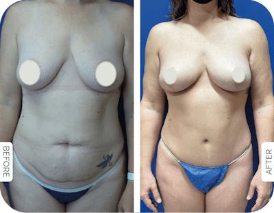 Miami Drainless Tummy Tuck Before & After Gallery - Patient 228563 - Image 1 - The Chopra Plastic Surgery Center