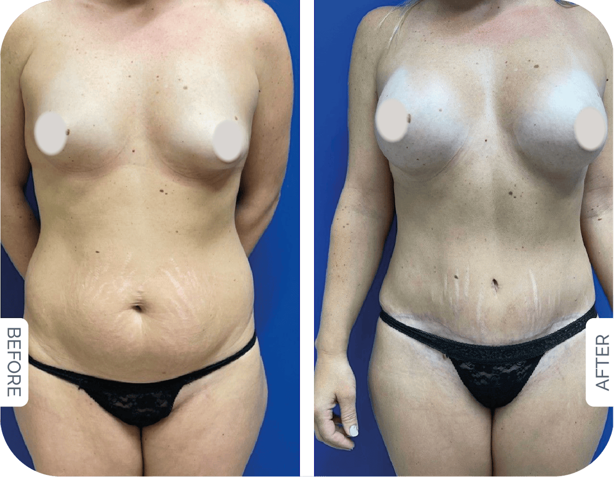 Miami Drainless Tummy Tuck Before & After Gallery - Patient 328773 - Image 1 - The Chopra Plastic Surgery Center