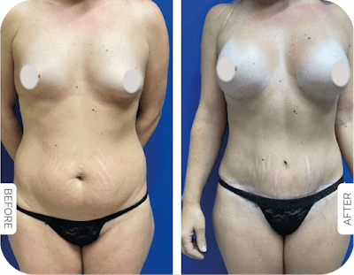 Miami Drainless Tummy Tuck Before & After Gallery - Patient 328773 - Image 1 - The Chopra Plastic Surgery Center