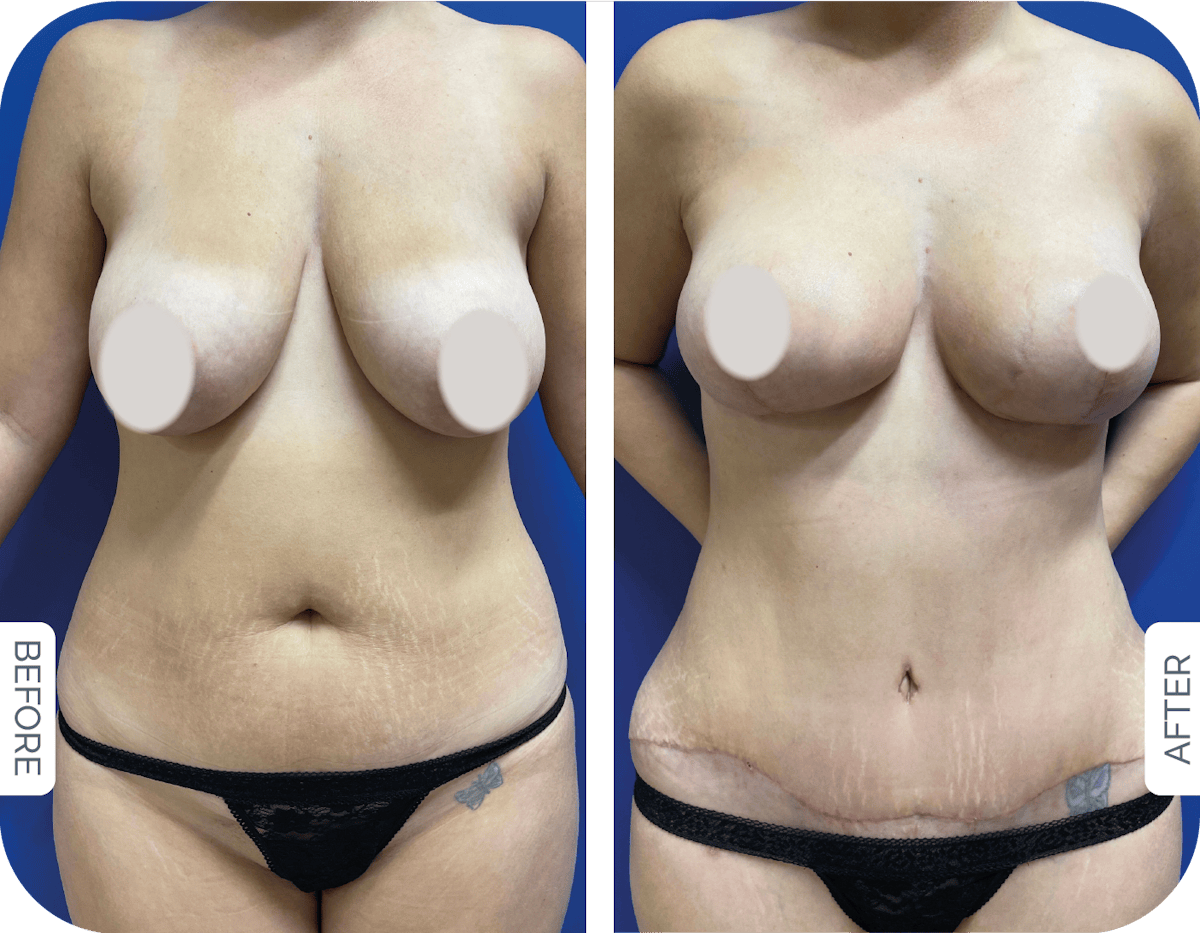 Miami Drainless Tummy Tuck Before & After Gallery - Patient 279378 - Image 1 - The Chopra Plastic Surgery Center