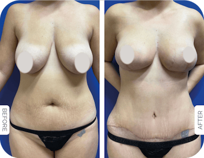 Miami Drainless Tummy Tuck Before & After Gallery - Patient 279378 - Image 1 - The Chopra Plastic Surgery Center