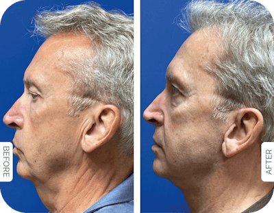Miami Male Facelift & Neck Lift Before & After Gallery - Patient 512211 - Image 1 - The Chopra Plastic Surgery Center