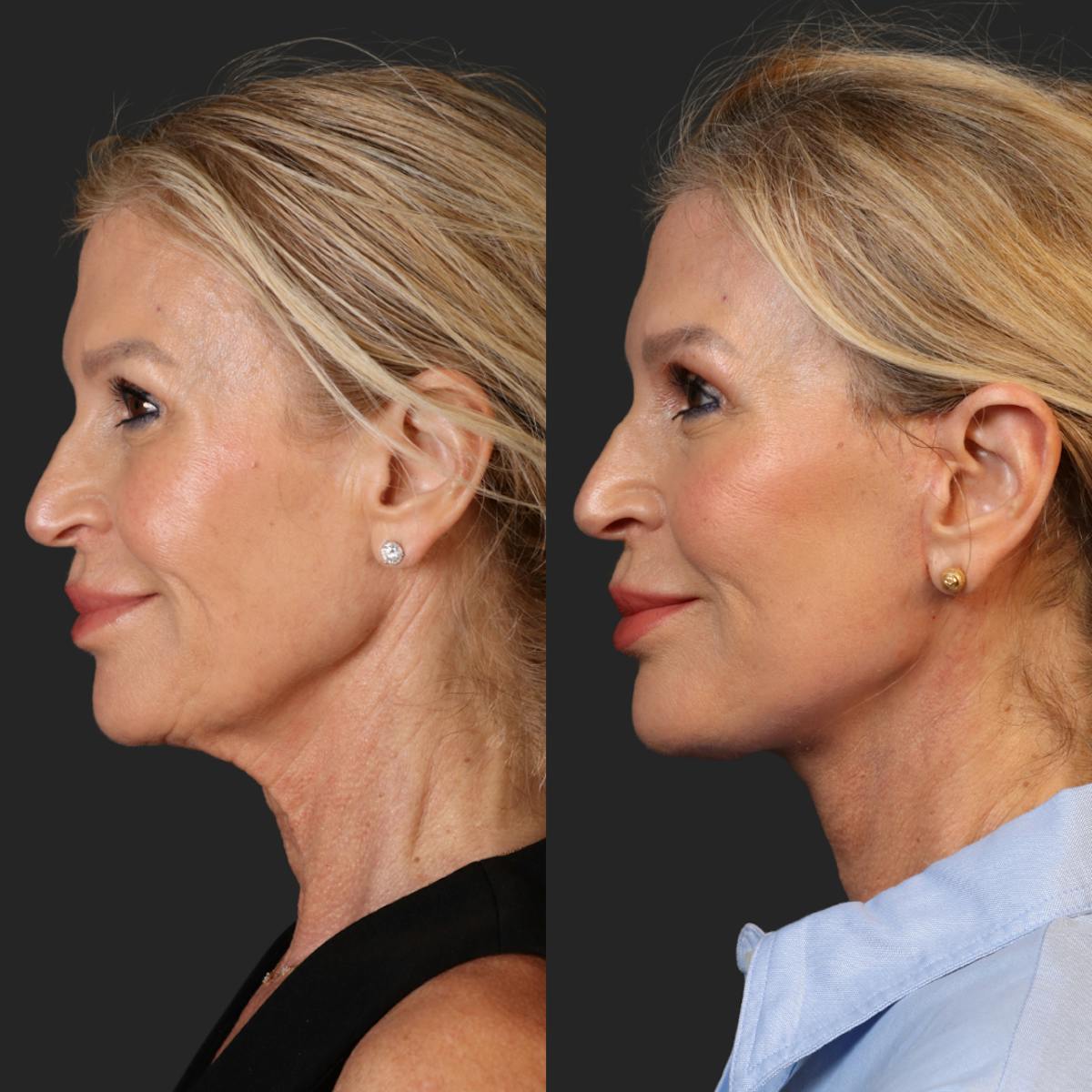 Miami Facelift/Neck Lift Before & After Gallery - Patient 343933 - Image 5 - The Chopra Plastic Surgery Center