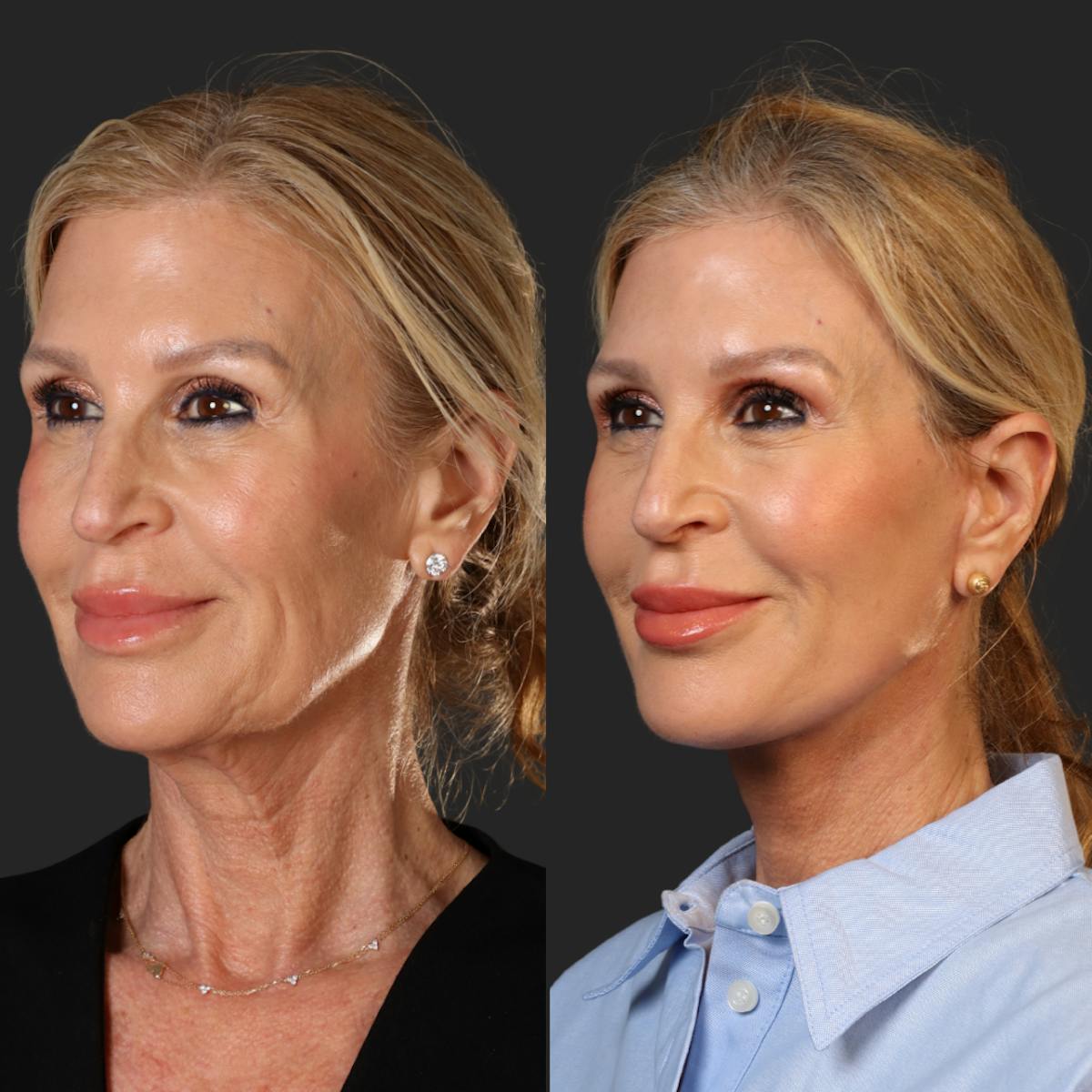 Miami Facelift/Neck Lift Before & After Gallery - Patient 343933 - Image 4 - The Chopra Plastic Surgery Center
