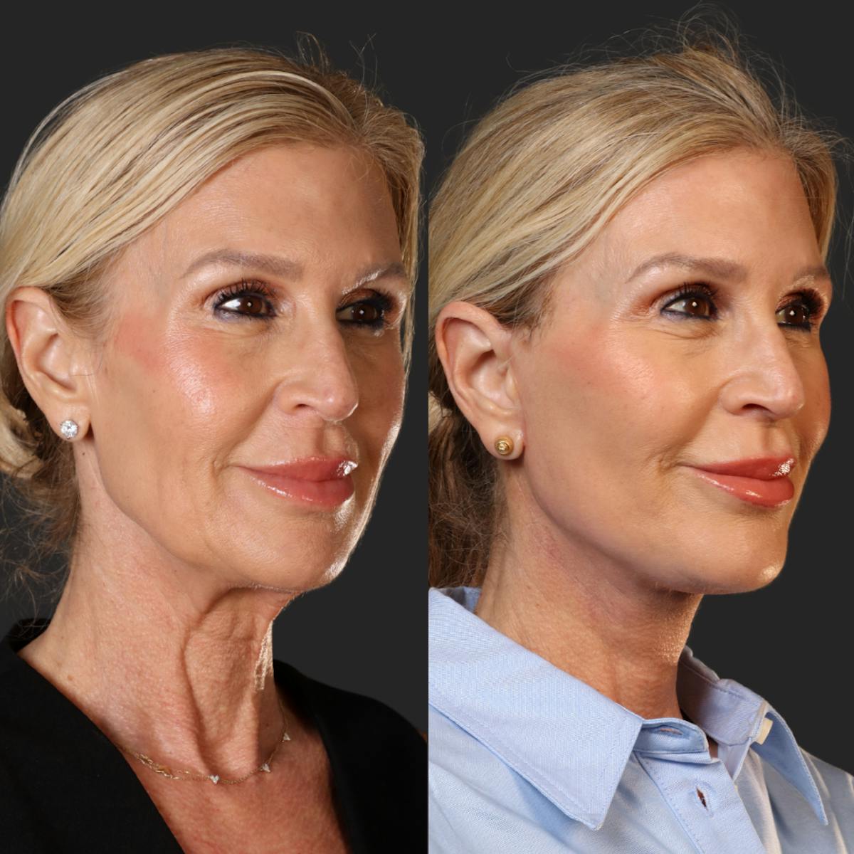Miami Facelift/Neck Lift Before & After Gallery - Patient 343933 - Image 2 - The Chopra Plastic Surgery Center
