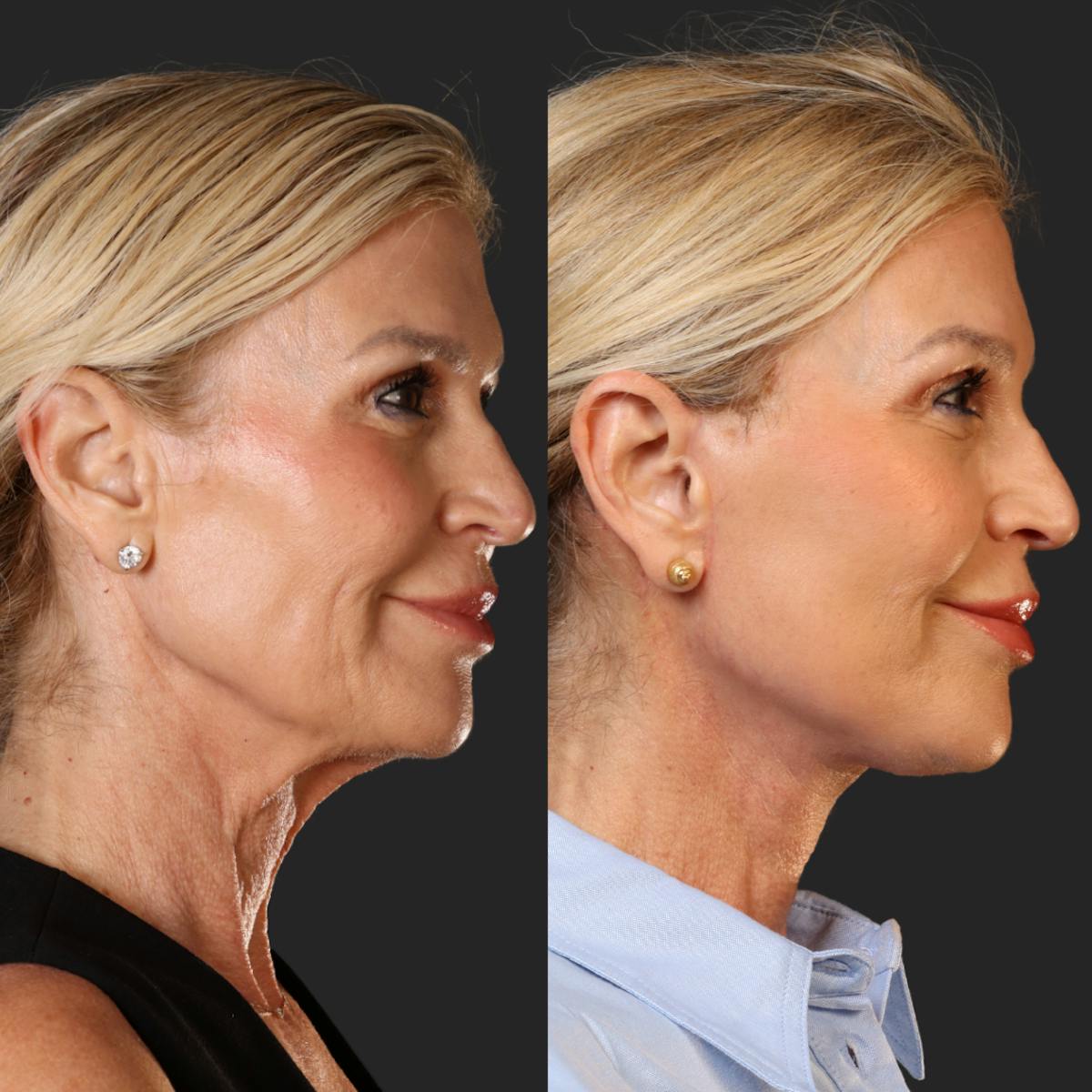 Miami Facelift/Neck Lift Before & After Gallery - Patient 343933 - Image 3 - The Chopra Plastic Surgery Center