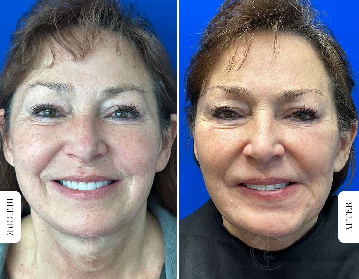 Miami Chin Augmentation Before & After Gallery - Patient 316274 - Image 4 - The Chopra Plastic Surgery Center