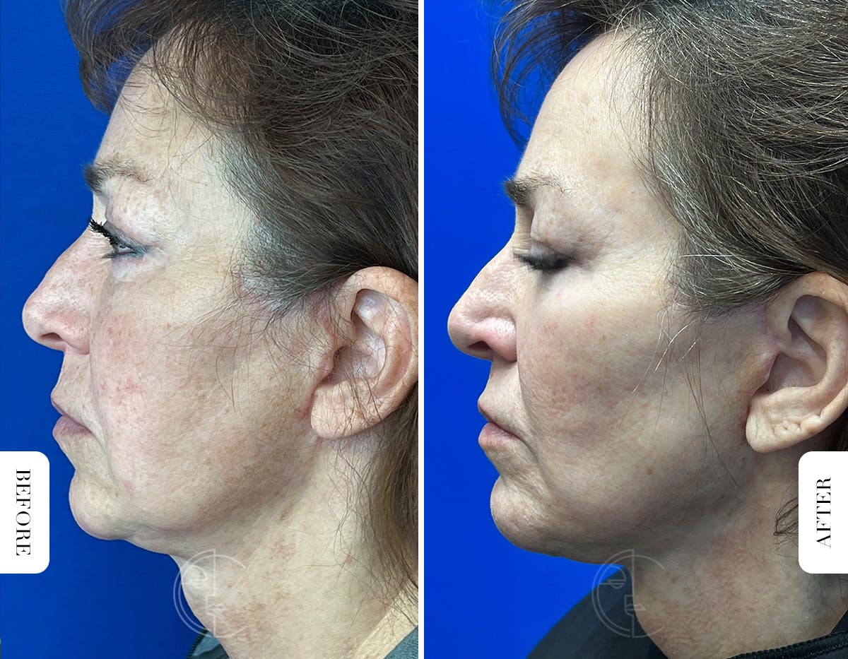Miami Chin Augmentation Before & After Gallery - Patient 316274 - Image 6 - The Chopra Plastic Surgery Center
