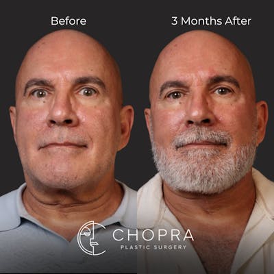 Miami Male Facelift & Neck Lift Before & After Gallery - Patient 132477 - Image 1 - The Chopra Plastic Surgery Center