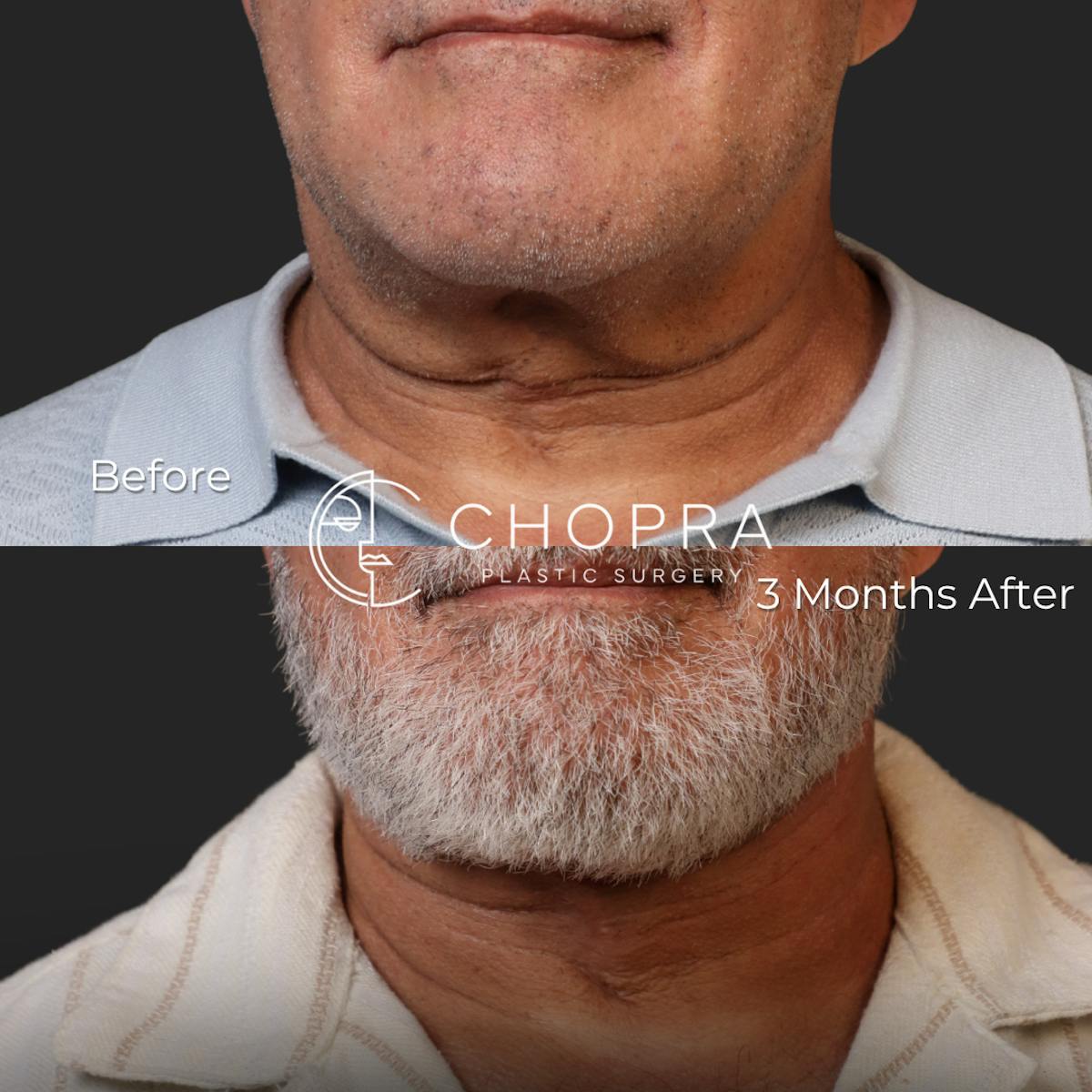 Miami Male Facelift & Neck Lift Before & After Gallery - Patient 132477 - Image 6 - The Chopra Plastic Surgery Center