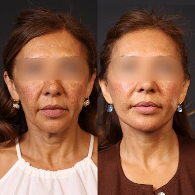Miami Facelift/Neck Lift Before & After Gallery - Patient 446208 - Image 1 - The Chopra Plastic Surgery Center
