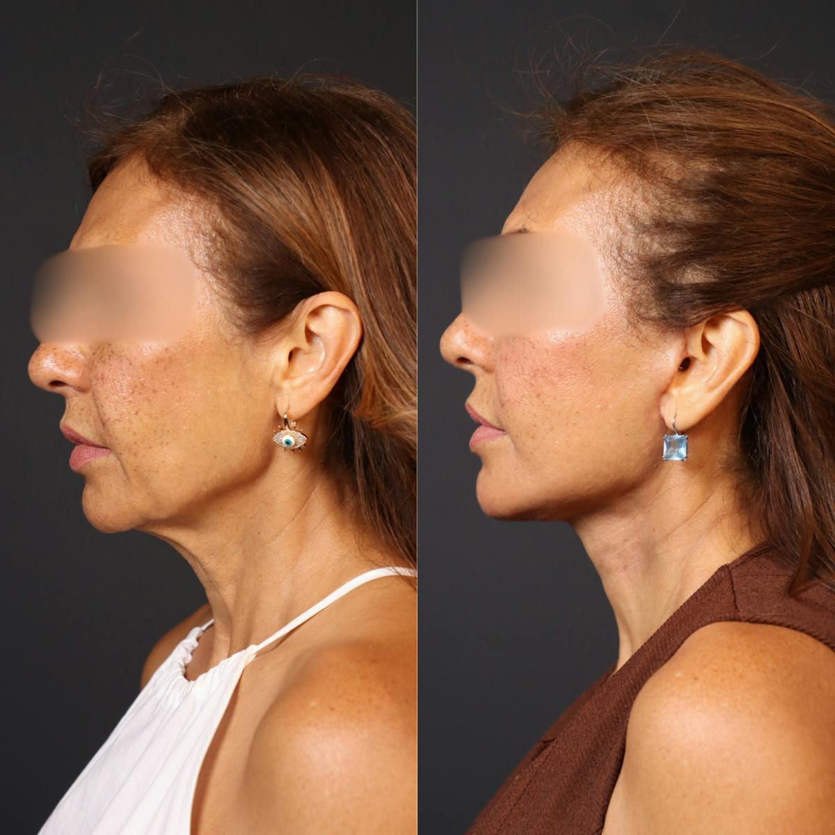 Miami Facelift/Neck Lift Before & After Gallery - Patient 446208 - Image 2 - The Chopra Plastic Surgery Center