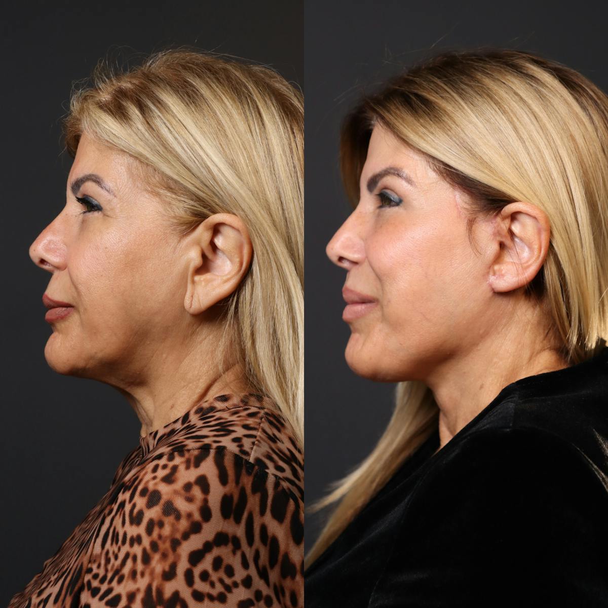 Miami Facelift/Neck Lift Before & After Gallery - Patient 187334 - Image 2 - The Chopra Plastic Surgery Center