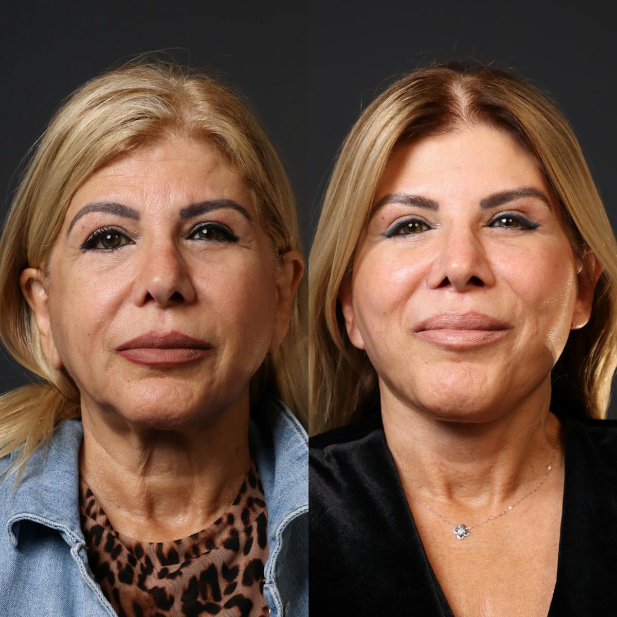 Miami Facelift/Neck Lift Before & After Gallery - Patient 187334 - Image 1 - The Chopra Plastic Surgery Center