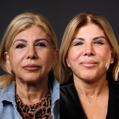 Miami Facelift/Neck Lift Before & After Gallery - Patient 187334 - Image 1 - The Chopra Plastic Surgery Center