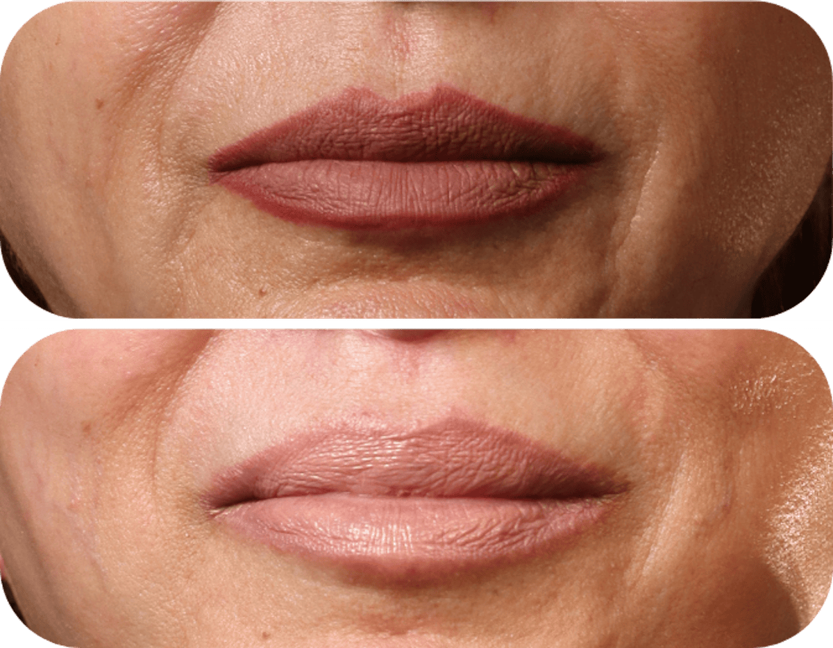 Miami Lip Lift Before & After Gallery - Patient 570911 - Image 1 - The Chopra Plastic Surgery Center