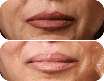 Miami Lip Lift Before & After Gallery - Patient 570911 - Image 1 - The Chopra Plastic Surgery Center