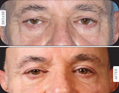 Miami Upper Eyelid Lift Before & After Gallery - Patient 421485 - Image 1 - The Chopra Plastic Surgery Center