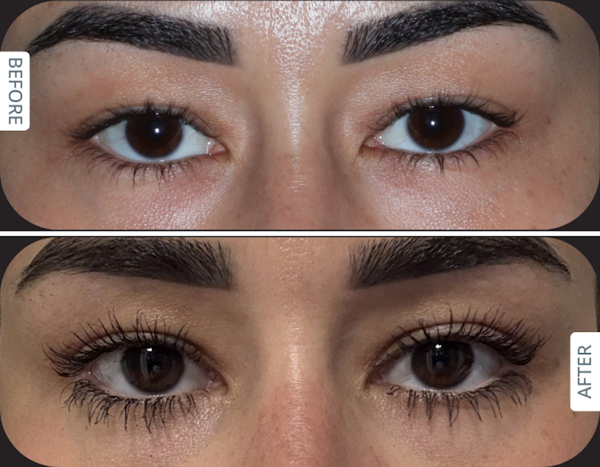 Miami Upper Eyelid Lift Before & After Gallery - Patient 807853 - Image 1 - The Chopra Plastic Surgery Center