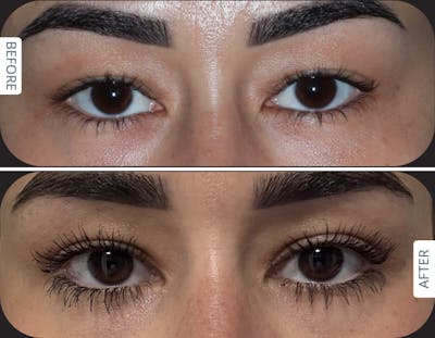 Miami Upper Eyelid Lift Before & After Gallery - Patient 807853 - Image 1 - The Chopra Plastic Surgery Center