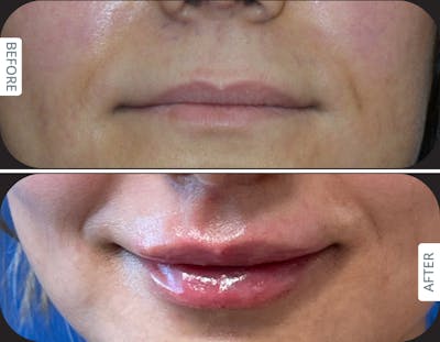 Miami Before and after Designer Deep Plane Lip Lift with fat transfer for natural lip volume enhancement in an international patient treated by Dr. Karan Chopra at Chopra Plastic Surgery in Miami. - The Chopra Plastic Surgery Center