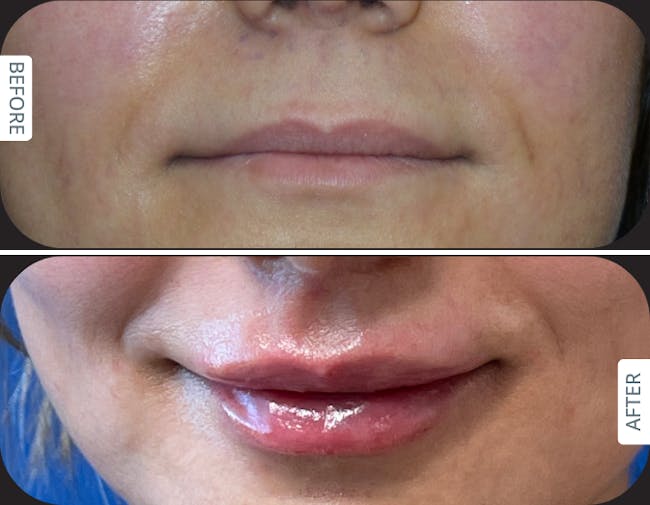 Before and after Designer Deep Plane Lip Lift with fat transfer for natural lip volume enhancement in an international patient treated by Dr. Karan Chopra at Chopra Plastic Surgery in Miami.