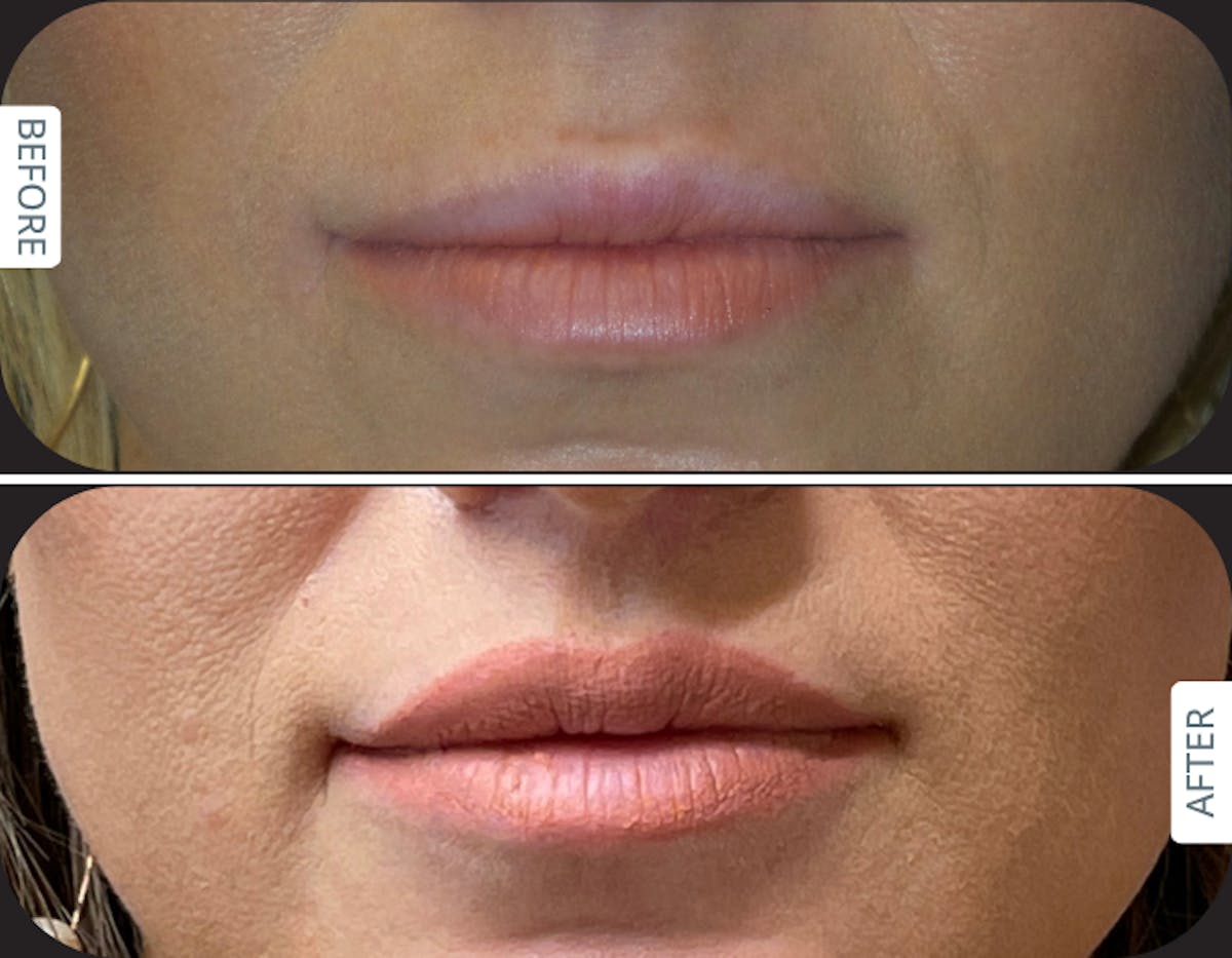 Miami Before and after Designer Deep Plane Lip Lift in a female patient in her 30s, shown 6 months after surgery by Dr. Karan Chopra at Chopra Plastic Surgery. - The Chopra Plastic Surgery Center