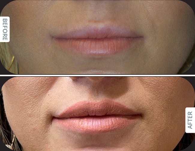 Before and after Designer Deep Plane Lip Lift in a female patient in her 30s, shown 6 months after surgery by Dr. Karan Chopra at Chopra Plastic Surgery.