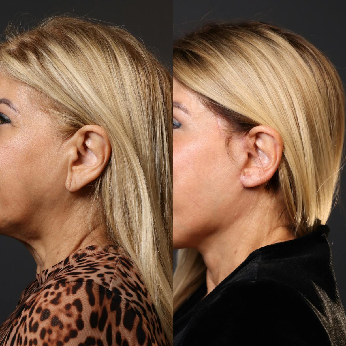Miami Earlobe Repair Before & After Gallery - Patient 184292 - Image 1 - The Chopra Plastic Surgery Center