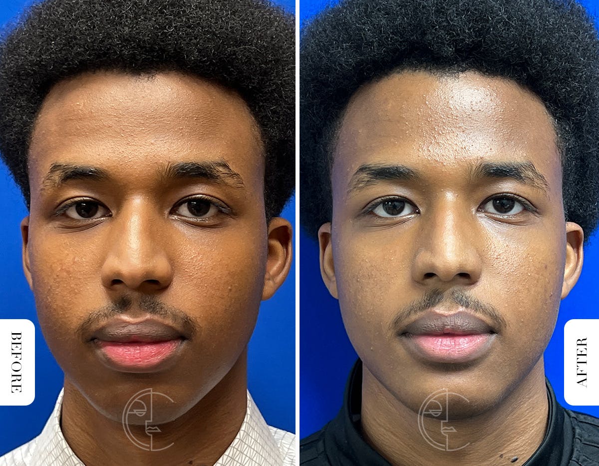 Miami Chin Augmentation Before & After Gallery - Patient 289564 - Image 1 - The Chopra Plastic Surgery Center