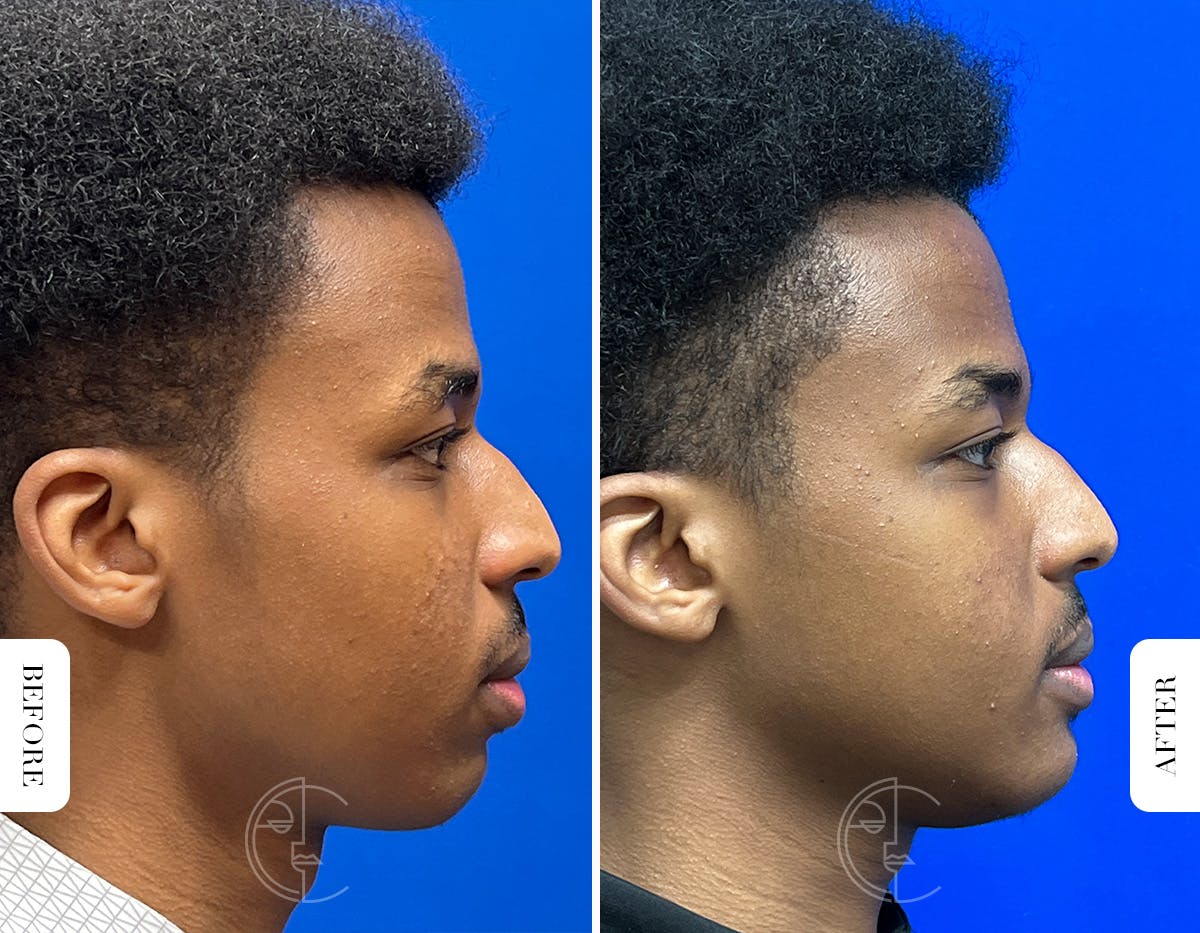 Miami Chin Augmentation Before & After Gallery - Patient 289564 - Image 2 - The Chopra Plastic Surgery Center