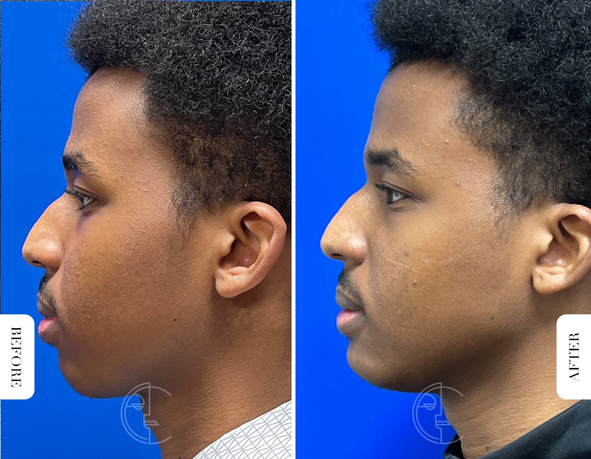Miami Chin Augmentation Before & After Gallery - Patient 289564 - Image 3 - The Chopra Plastic Surgery Center