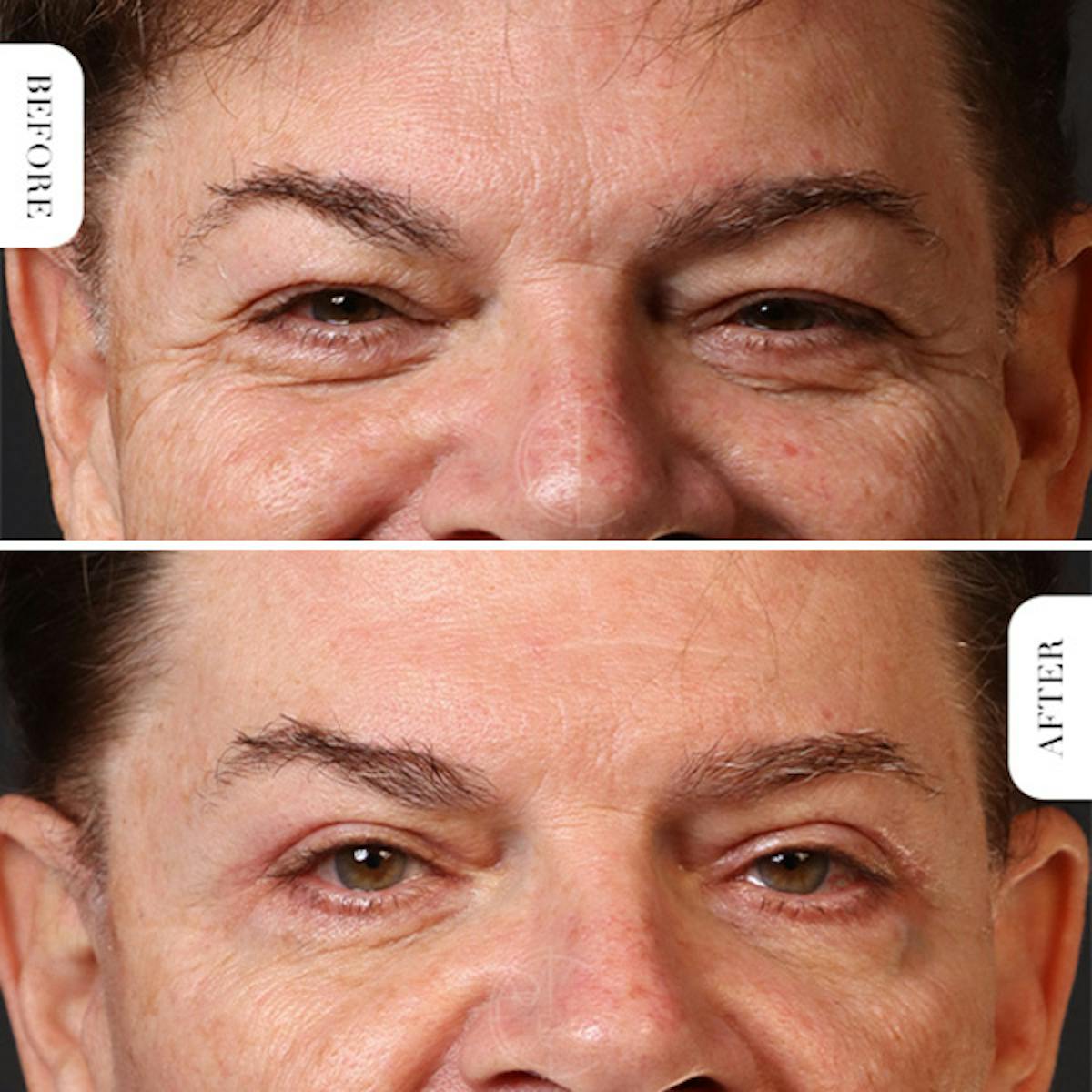 Miami Upper Eyelid Lift Before & After Gallery - Patient 128815 - Image 1 - The Chopra Plastic Surgery Center