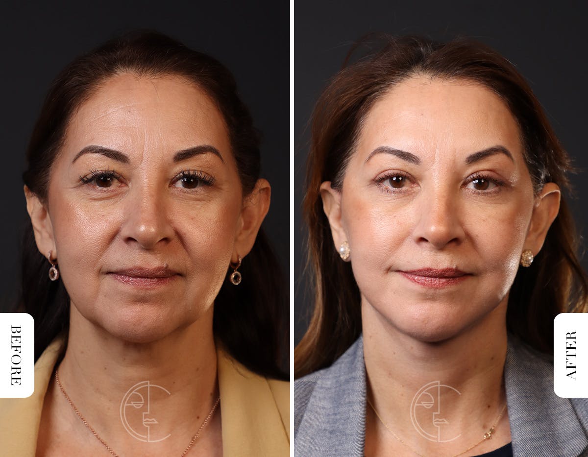 Miami Facelift/Neck Lift Before & After Gallery - Patient 176378 - Image 3 - The Chopra Plastic Surgery Center